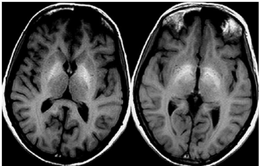 뇌 MRI T1 강조영상(T1WI) 축상면에서 양측 창백핵(Globus pallidus)에 대칭적인 고신호강도가 관찰됨.
