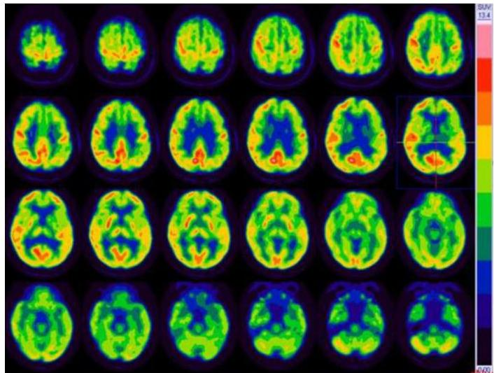Brain FDG-PET