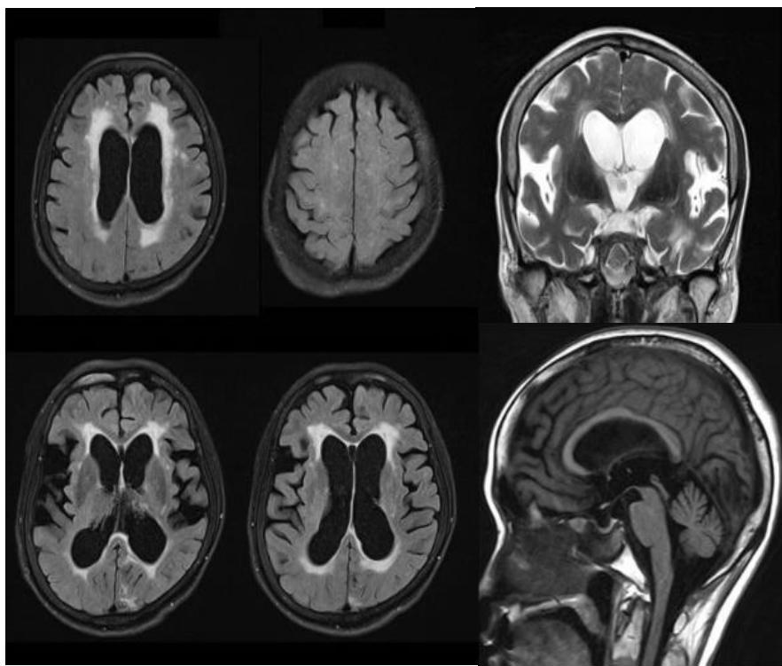 뇌 MRI