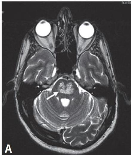 MRI T2-weighted image