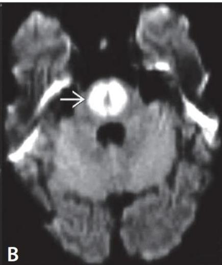 MRI Diffusion-weighted image