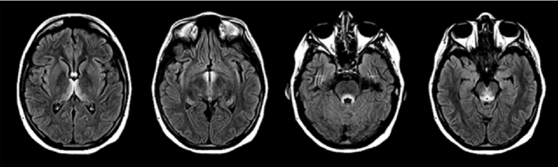 뇌 MRI 영상: 시상 내측(medial thalamus)과 수도관 주위(periaqueductal area)에 대칭적인 고신호강도가 관찰됨.