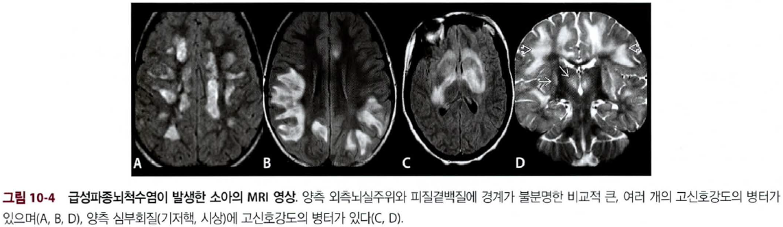 ADEM vs MS 감별 표