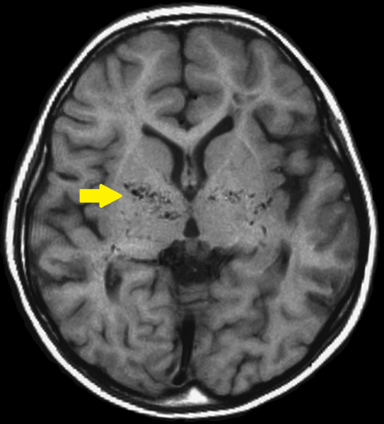 MRI FLAIR 영상에서 뇌 표면을 따라 보이는 ivy sign