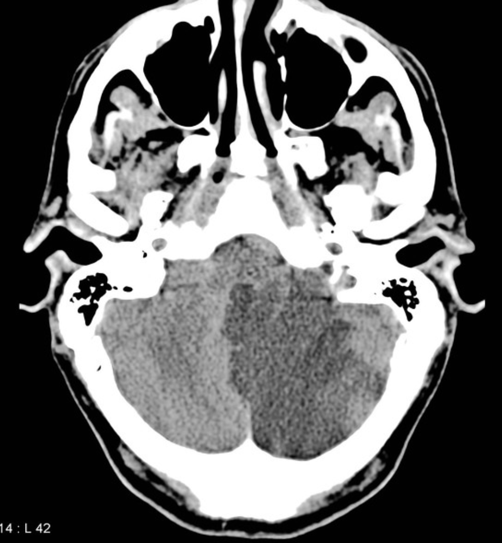 내원 당시 뇌 MRI: 우측 소뇌 뒤아래소뇌동맥(PICA) 영역에 고신호강도의 급성 뇌경색 소견이 관찰됨.