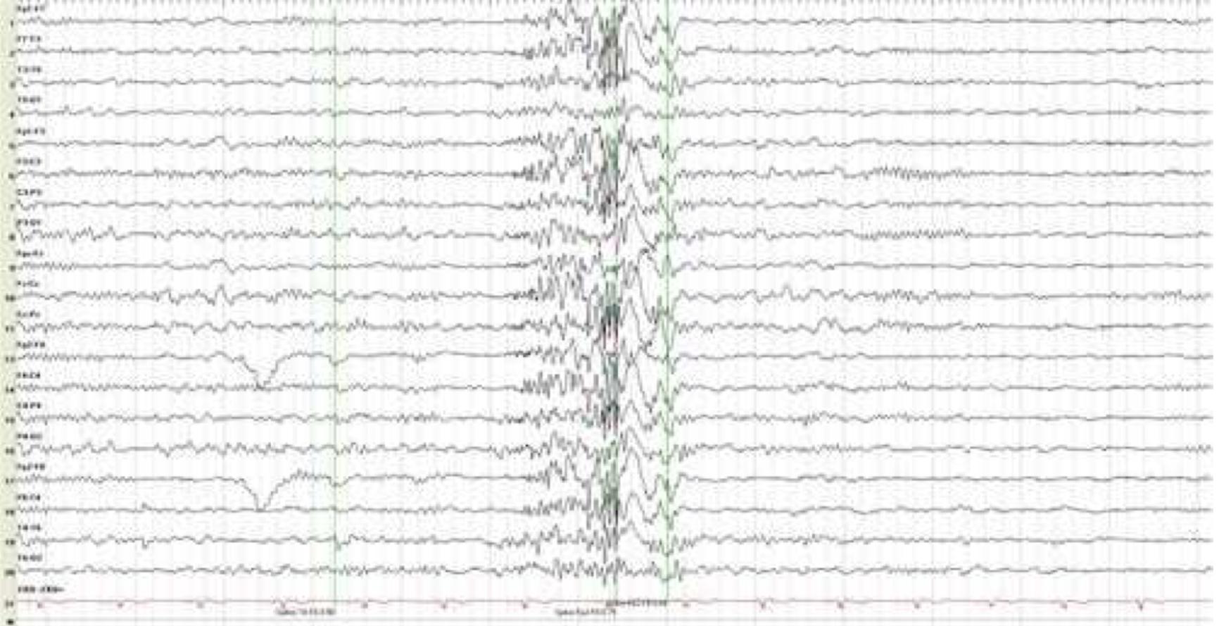 EEG