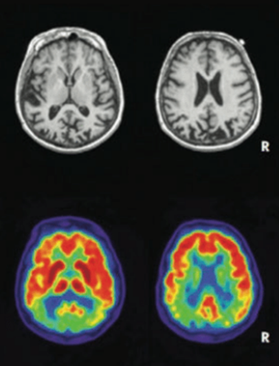 Brain MRI and PET scan