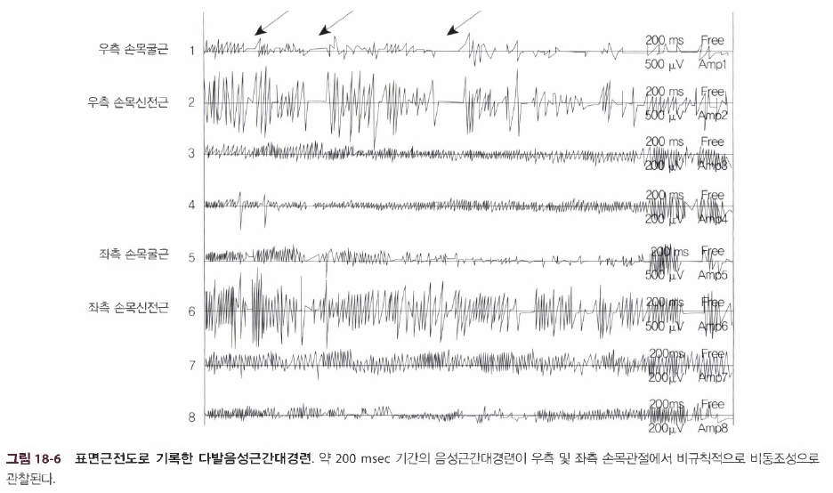 이상운동질환별 근전도 감별