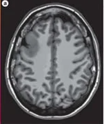 Brain MRI T2-FLAIR axial view showing a high signal intensity lesion in the right frontal lobe.