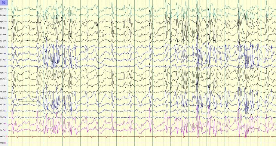 EEG of Lennox-Gastaut Syndrome showing slow spike-and-wave