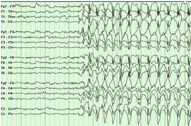 EEG showing 3Hz generalized spike-and-wave discharges
