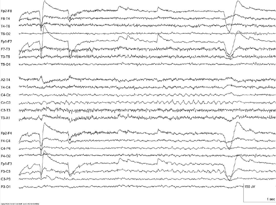 Midline theta rhythm 예시