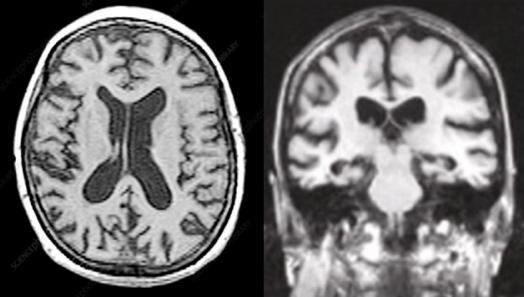 Brain MRI (FLAIR axial & coronal): Bilateral medial temporal lobe atrophy (Scheltens grade 2)