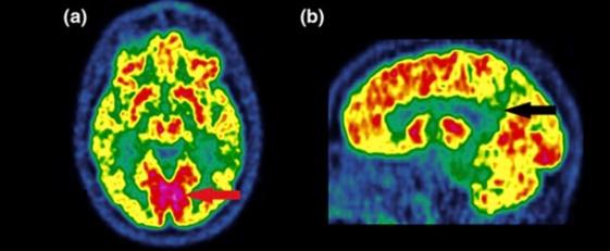 FDG-PET (Sagittal): Hypometabolism in the posterior cingulate and parietal cortex