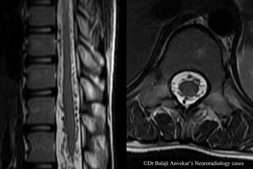 경추 MRI