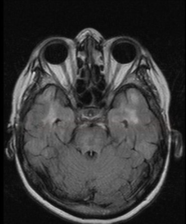 Brain MRI FLAIR/T2: Extensive leukoencephalopathy with characteristic involvement of the temporal poles.
