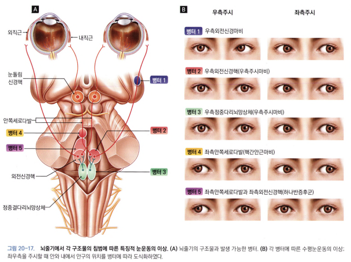 MRI 및 모식도