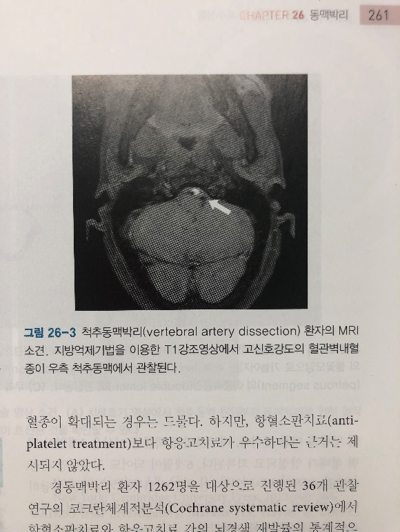 동맥박리의 MRI 소견: 벽내혈종에 의한 반달 모양(Crescent sign)