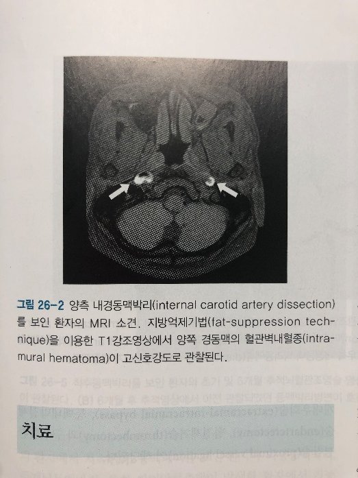 동맥박리의 혈관조영술 소견: String sign 및 Tapering