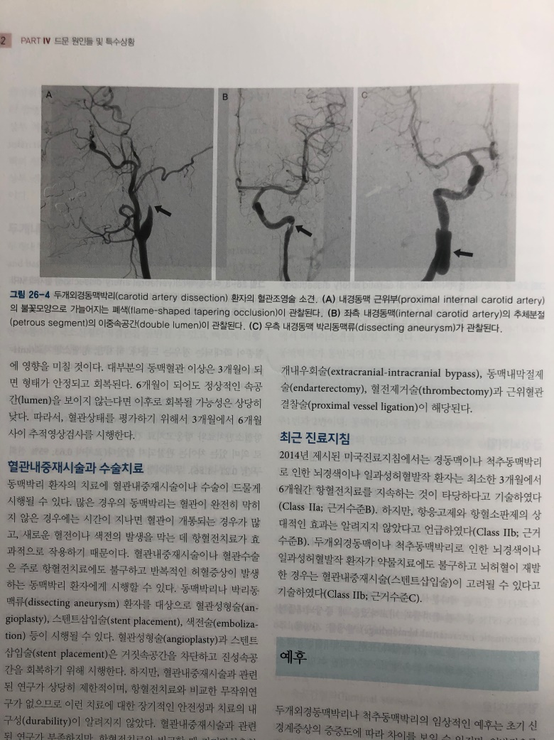 경동맥 박리의 모식도: 내막 파열 및 벽내혈종 형성 과정