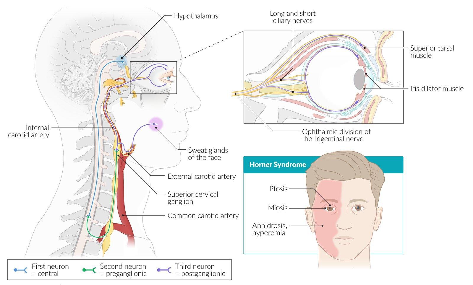교감신경 경로 모식도. 시상하부에서 시작하여 척수 T1-T3를 거쳐 상경신경절로 이어지는 1, 2, 3차 뉴런의 주행 경로와 호너 증후군의 증상(안검하수, 축동, 무한증)을 설명하는 그림