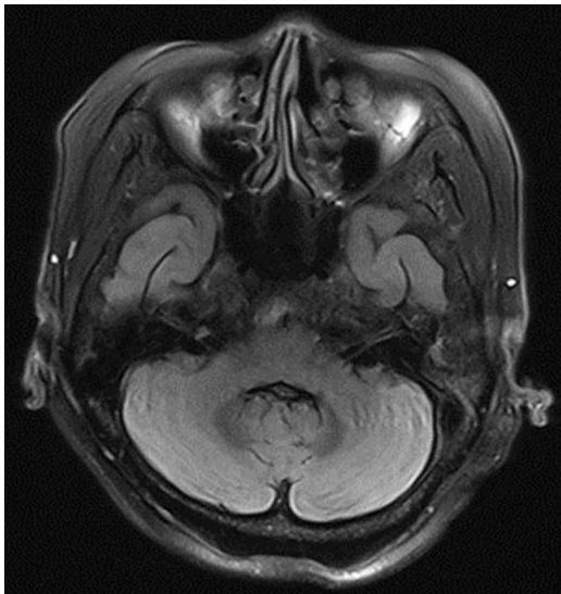 뇌 MRI FLAIR 축상면 영상에서 양측 소뇌 치상핵 부위에 대칭적인 고신호강도가 관찰됨.
