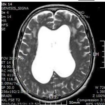 뇌 MRI T2 강조 영상 axial view. 측뇌실(lateral ventricles)이 현저하게 확장되어 있으며, 주변 뇌피질의 위축(cortical atrophy)은 상대적으로 적어 보이는 정상압 수두증 소견을 보임.