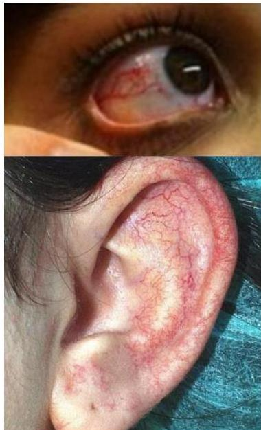 안구 결막과 귓바퀴에 나타난 선형의 모세혈관 확장증(telangiectasia) 사진