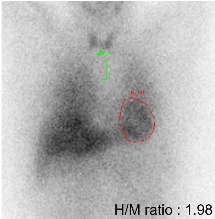 Cardiac 123I-MIBG scintigraphy