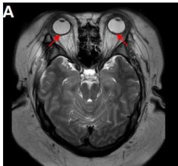 뇌 MRI T2 Axial