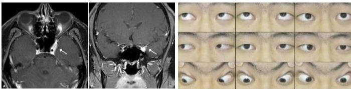 MRI 및 안구운동 사진