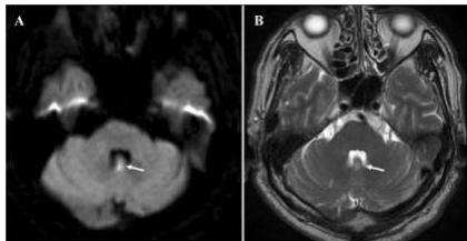 뇌 MRI 영상