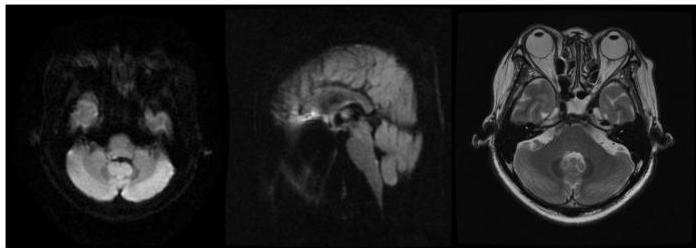 뇌 MRI