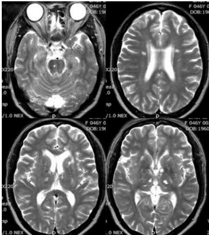 뇌 MRI T2 강조영상