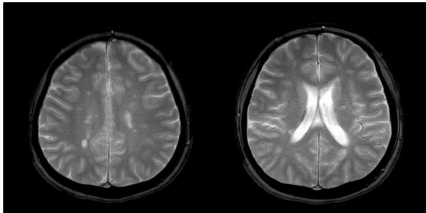 Brain MRI T2-weighted axial images showing multiple hyperintense lesions in periventricular and subcortical white matter.