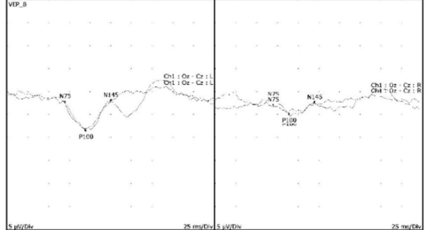 Visual Evoked Potential (VEP) recording showing waveforms for the left and right eyes; the right eye shows significantly reduced amplitude and delayed P100 latency.