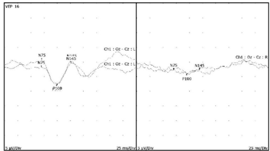 Additional VEP recording confirming abnormal conduction in the visual pathway, consistent with optic neuritis.