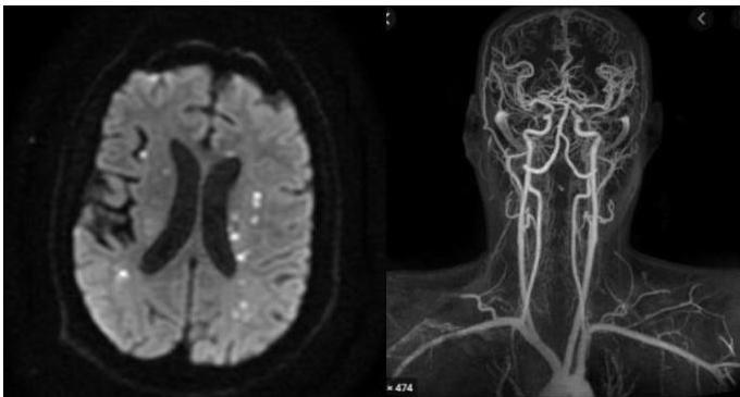 MRI 및 Angiography