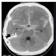 Brain CT axial