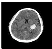 Brain CT axial showing hemorrhage