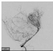 Cerebral Angiography