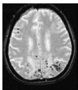 Brain MRI T2* GRE/SWI showing microhemorrhages