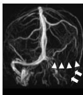 MR Venography showing filling defect in left transverse sinus