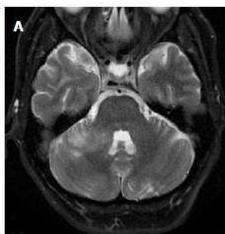 T2-weighted axial MRI showing hyperintensity in the right lateral pons and middle cerebellar peduncle.