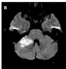 Diffusion-weighted imaging (DWI) showing a bright high-signal lesion in the right middle cerebellar peduncle, indicating acute infarction.