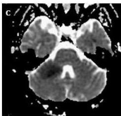 Apparent Diffusion Coefficient (ADC) map showing corresponding low signal in the right middle cerebellar peduncle, confirming restricted diffusion.