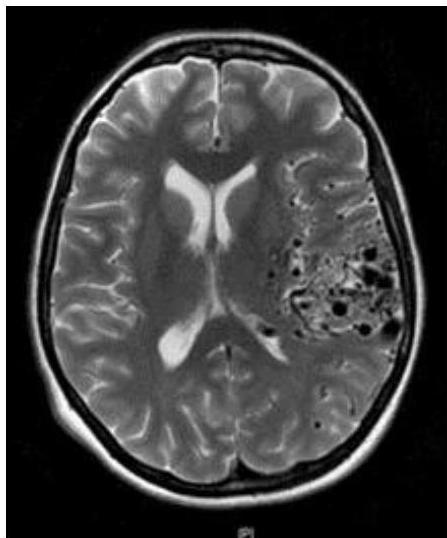 Brain MRI T2-weighted axial image showing a cluster of flow voids in the left temporoparietal region, consistent with a nidus of an arteriovenous malformation.