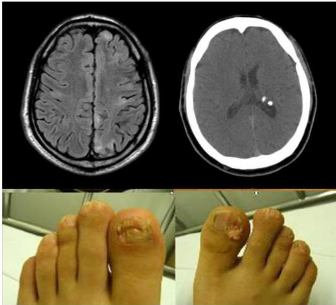 Brain MRI and CT, Foot findings