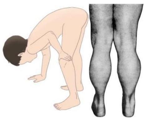 가워 징후(Gowers' sign)를 보이는 아이의 삽화와 장딴지 가성 비대(pseudohypertrophy)를 보여주는 실제 다리 사진