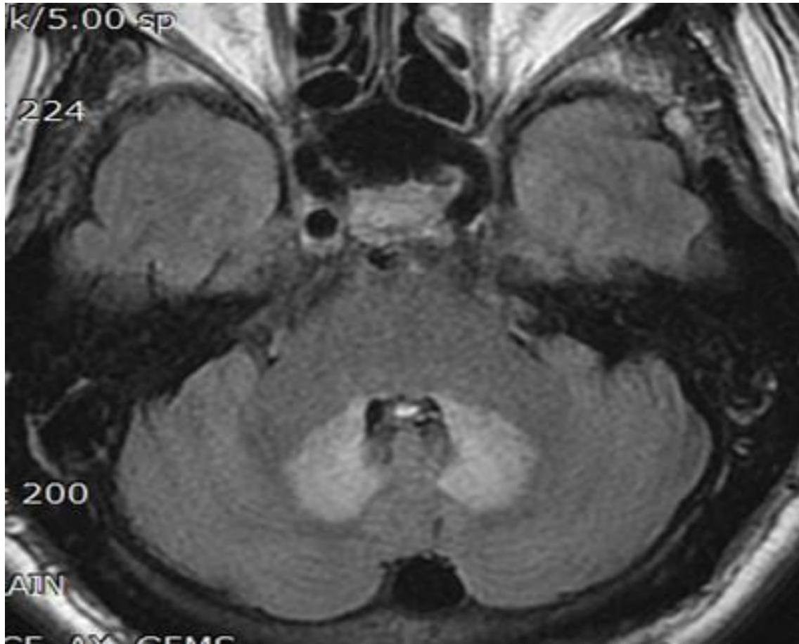 뇌 MRI FLAIR 축상면 영상에서 양측 소뇌 치상핵(dentate nuclei) 부위에 대칭적인 고신호강도가 관찰됨.